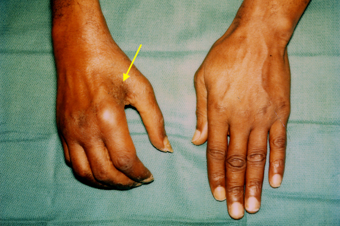 complex-regional-pain-syndrome-crps-hand-surgery-source